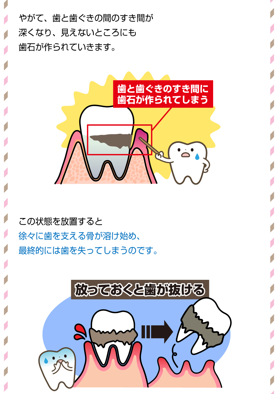 放置すると歯が抜ける！？「歯石」のリスクとは？3